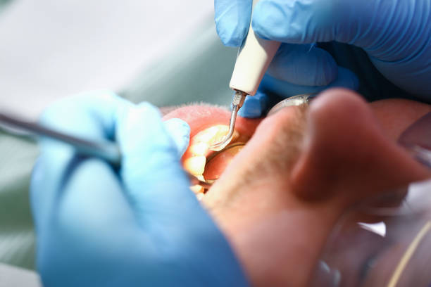 Best Emergency Treatment for Dental Infections or Abscesses in Harrisburg, NC
